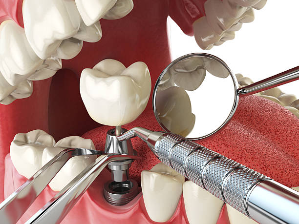 Best Emergency Dentist for Knocked-Out Tooth in Woodbranch, TX